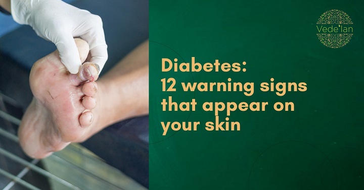 Diabetes: 12 warning signs that appear on your skin