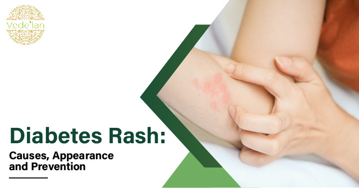 Diabetes Rash: Causes, Appearance and Prevention
